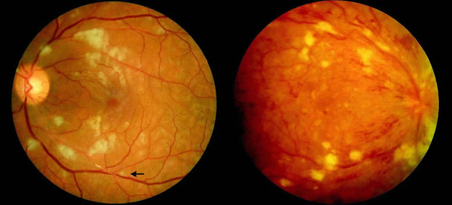 Hur hepatit B påverkar dina ögon