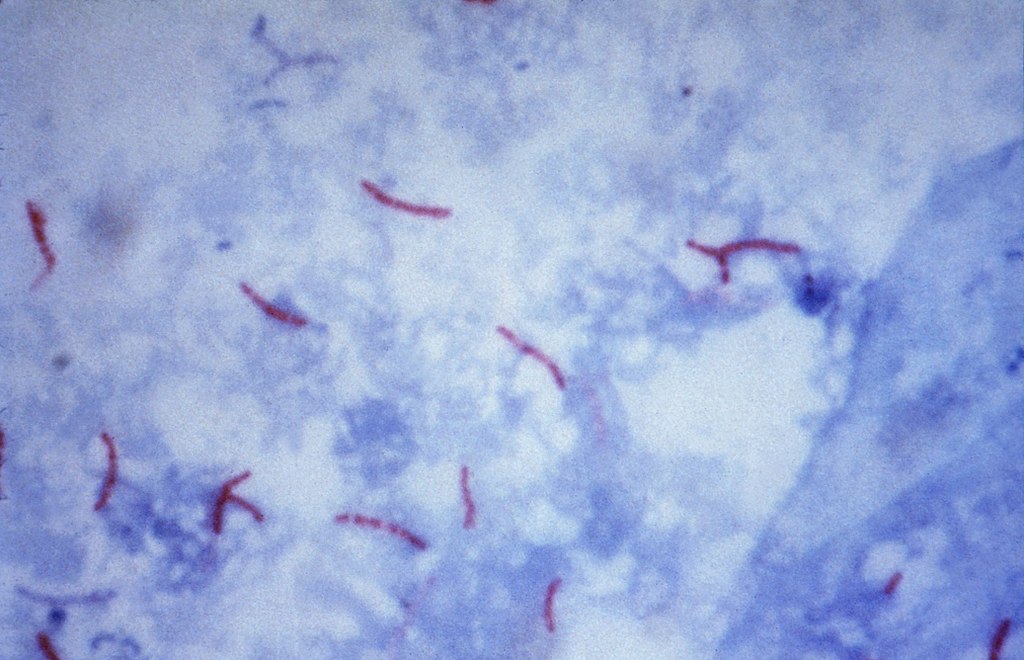 Mycobacterium tuberculosis Ziehl-Neelsen fläck 02.jpg