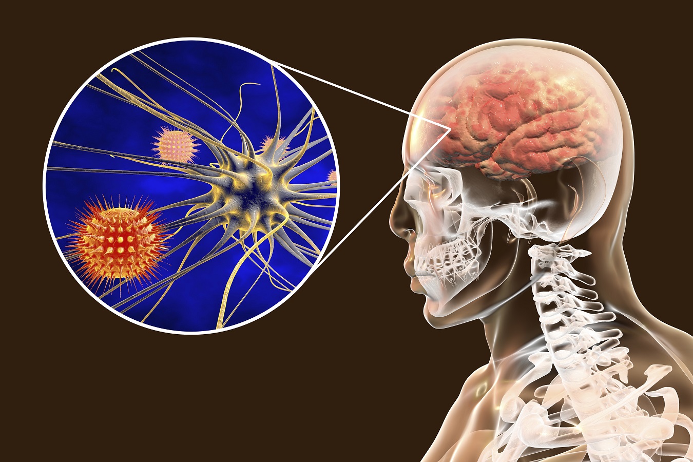 Bakteriell hjärnhinneinflammation: symtom och behandling