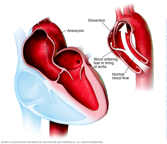 Aortaaneurysm och aortadissektion