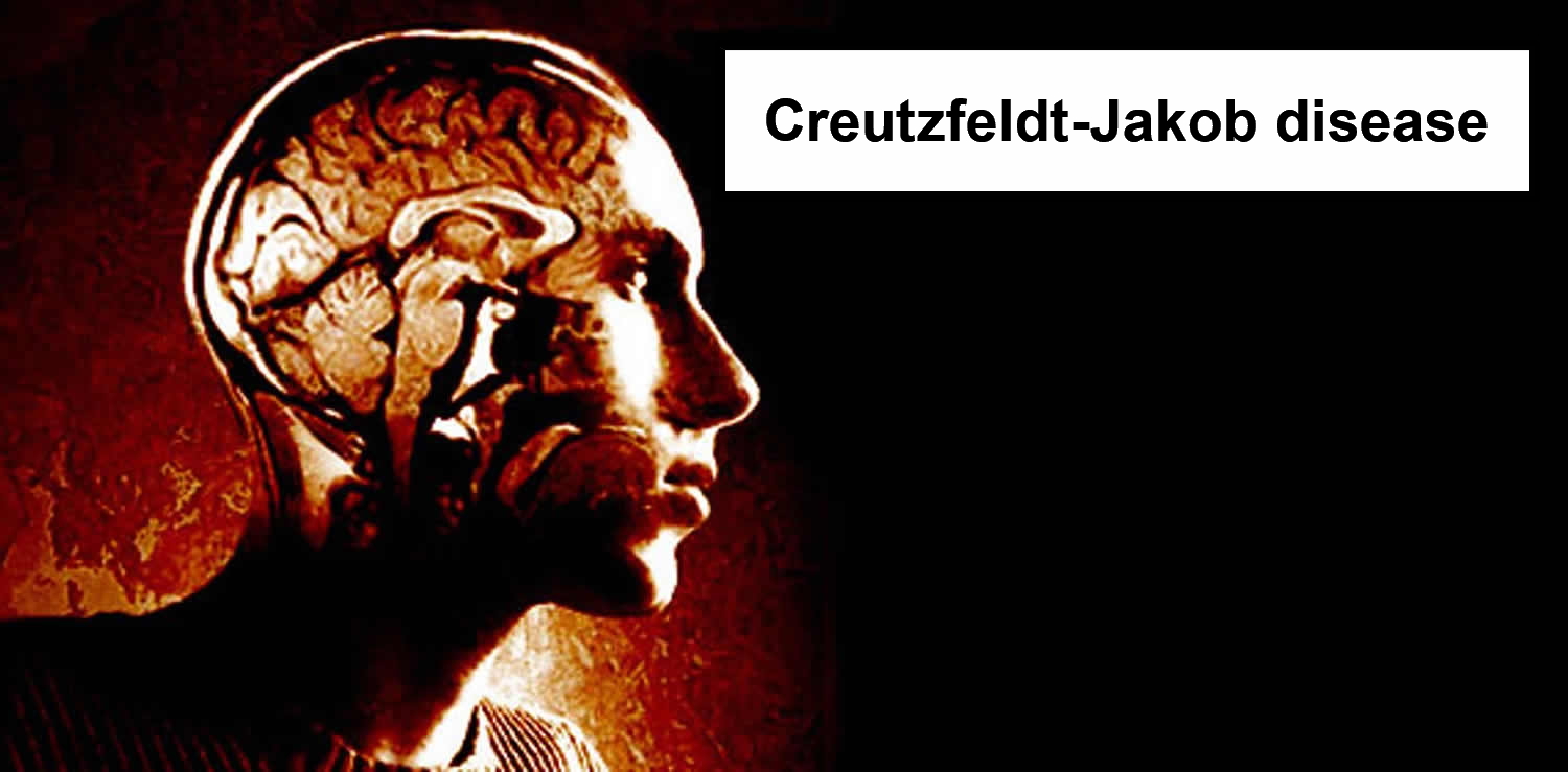http://medicinsk.net/wp-content/uploads/2020/12/Creutzfeldt-Jakob-disease.jpg