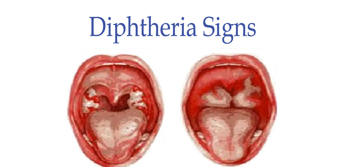 Difteri: orsaker, symtom och behandling