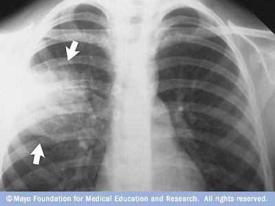 Röntgenbild av lungor med lunginflammation