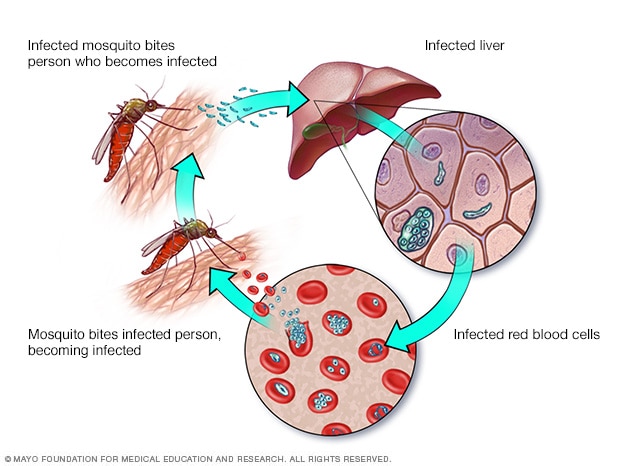 Malaria: orsaker, symtom och behandling