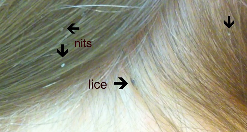1. How to Get Rid of Head Lice in Blonde Hair - wide 4