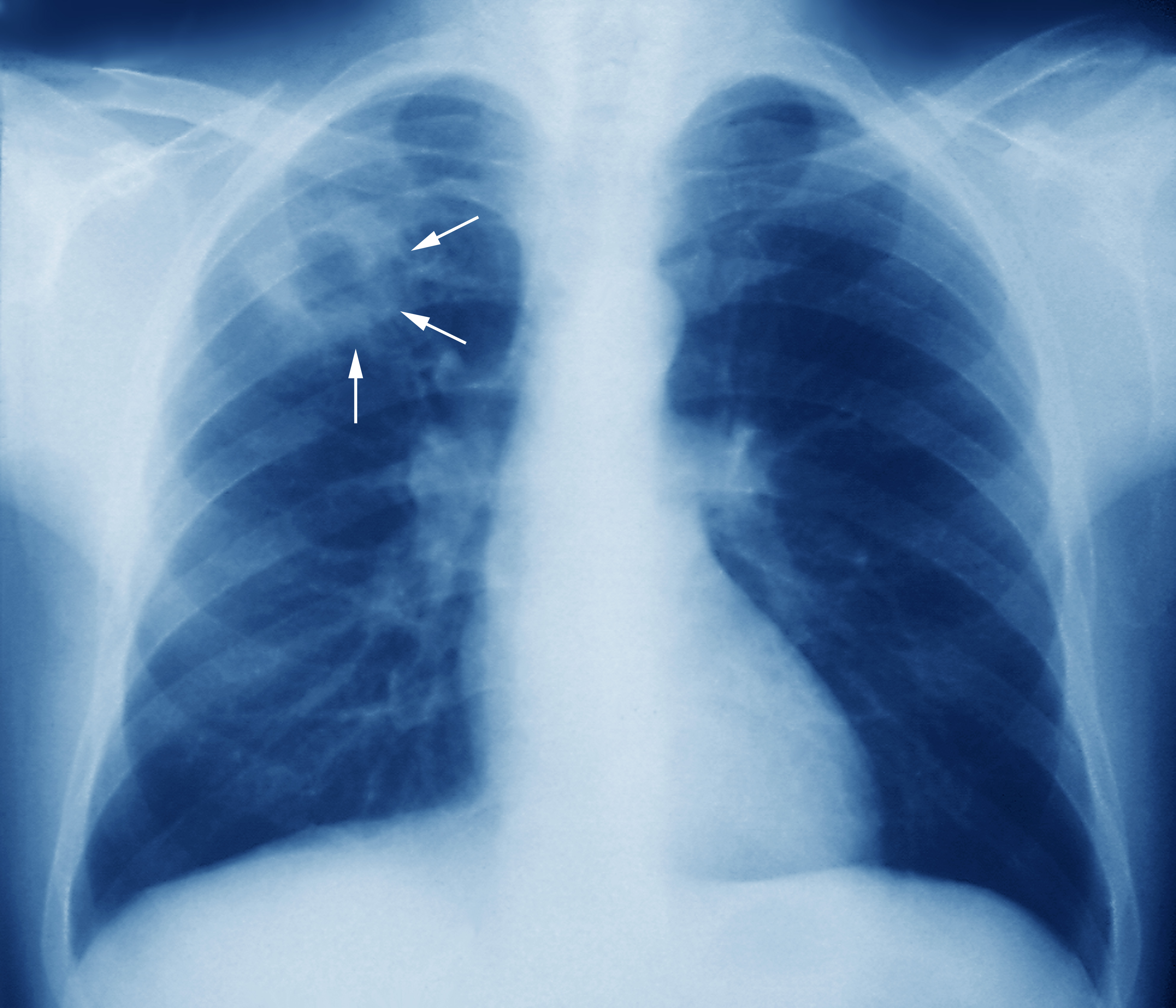 http://medicinsk.net/wp-content/uploads/2020/12/m2700245-tuberculosis-chest-x-ray-science-photo-library-high.jpg