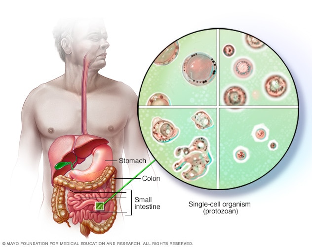 Blastocystis hominis - orsaker, symtom och behandling