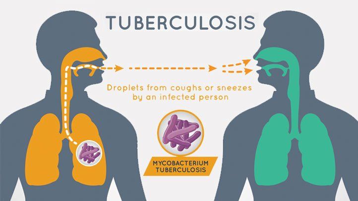 Tuberkulos: orsaker, symtom och behandling