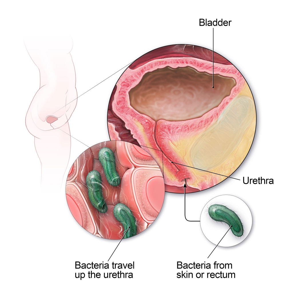 Hos kvinnor kan bakterier från huden eller ändtarmen färdas upp urinröret och orsaka urinblåsans infektion.