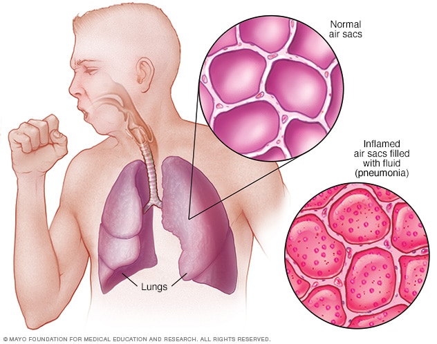 Lunginflammation: orsaker, symtom och behandling