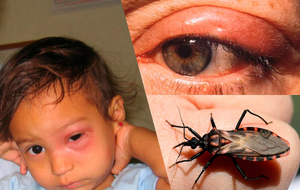 Chagas sjukdom: symptom, orsaker och behandling